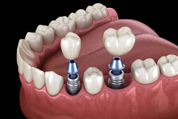 Dental Implants
